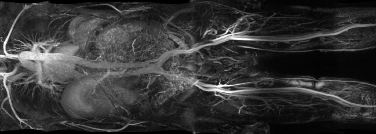 3T MRI using ablavar MRI contrast to show the organs in a black and white scan of a human