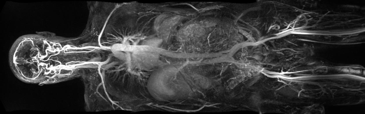 3T MRI using ablavar MRI contrast to show the organs in a black and white scan of a human